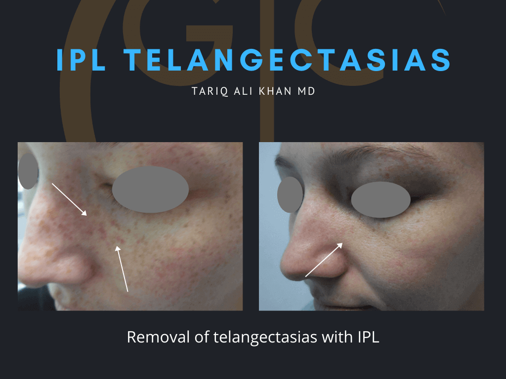 Gentle Care Laser Tustin Before and After picture - IPL telangectasia
